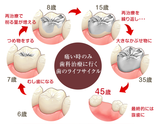 歯のライフサイクル