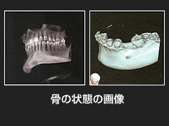 歯科CT