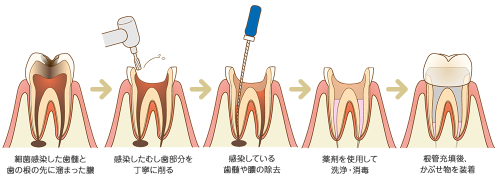 歯の根の治療順番