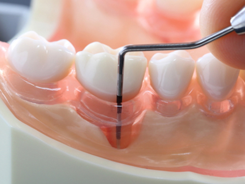 プロービング検査